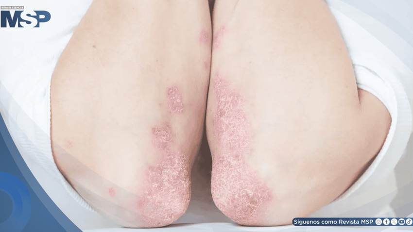 Pústulas, fiebre y riesgo de sepsis: Así se trata la psoriasis pustular generalizada