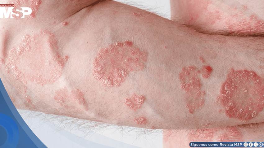 Por qué la psoriasis vuelve siempre al mismo lugar: Así funciona la 