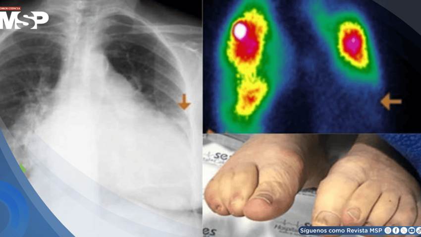 Diagnóstico y manejo de coma mixedematoso en paciente con hipotiroidismo e insuficiencia cardíaca