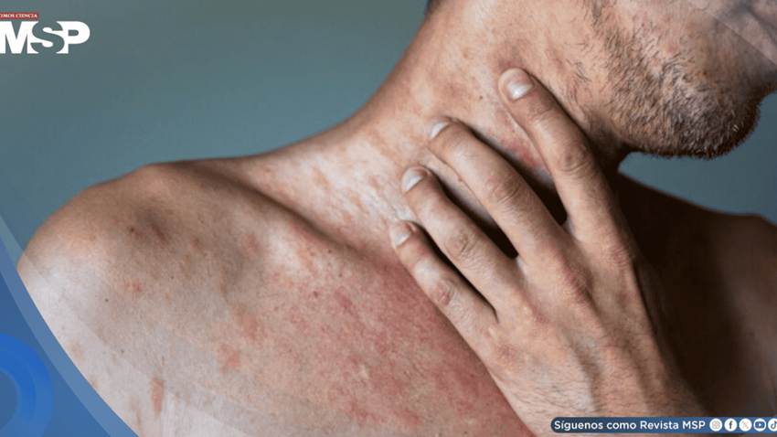 Estos son los nueve factores que podrían desencadenar la urticaria crónica, según estudio