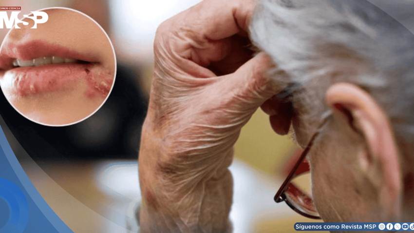 Estudio revela que el virus del herpes podría contribuir al desarrollo de la enfermedad de Alzheimer