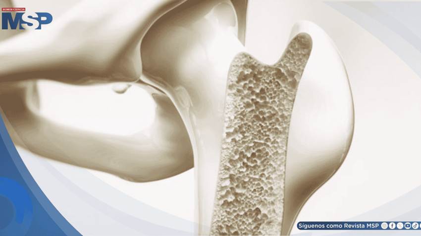 Desarrollan hidrogel inyectable que aumenta densidad ósea y reduce riesgo de fracturas en osteoporosis