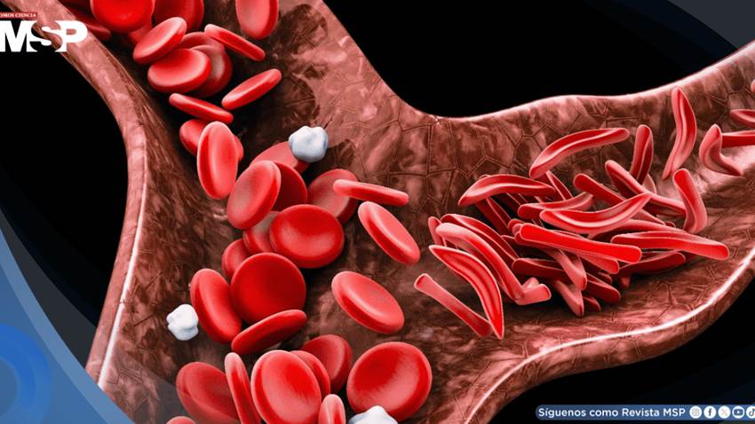 Nuevo tratamiento oral reduce en 27% las crisis de dolor en pacientes con anemia falciforme