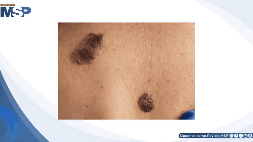 Melanoma invasivo: el 