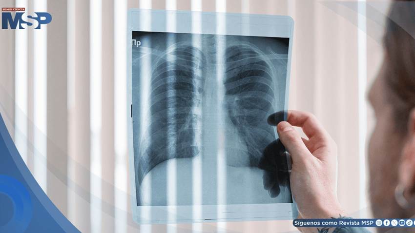 Crean tratamiento oral supera a la quimioterapia en un difícil subtipo de cáncer de pulmón
