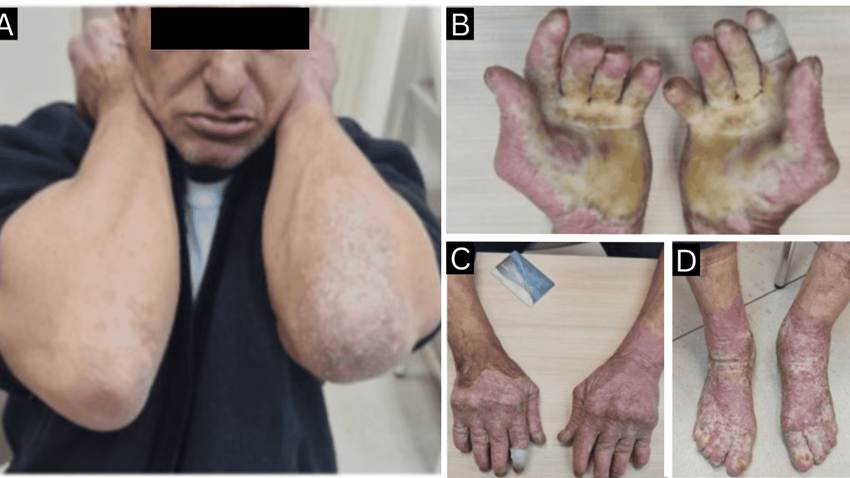 Hombre con hiperqueratosis epidermolítica desarrolla artritis inflamatoria y responde a metotrexato
