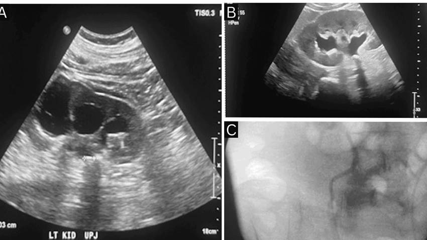 Obstrucción ureteropélvica bilateral secundaria a nefrolitiasis como causa de crisis hipertensiva