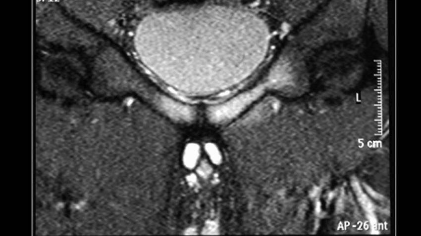 Atleta de 24 años desarrolla osteomielitis púbica por bacteria oral tras extracción dental