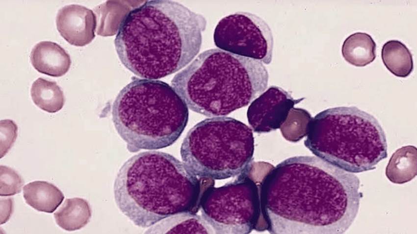 Prueba de médula ósea podría duplicar la supervivencia en jóvenes con leucemia mieloide aguda