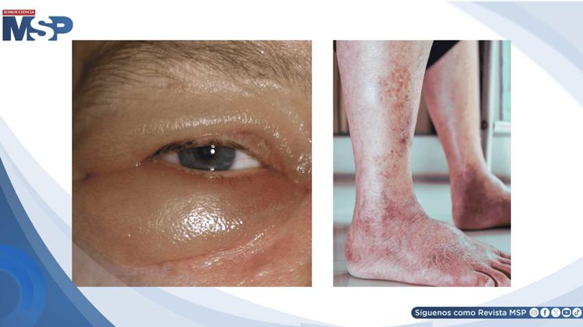 Edema progresivo y aumento de peso revelan síndrome nefrótico asociado a diabetes mal controlada