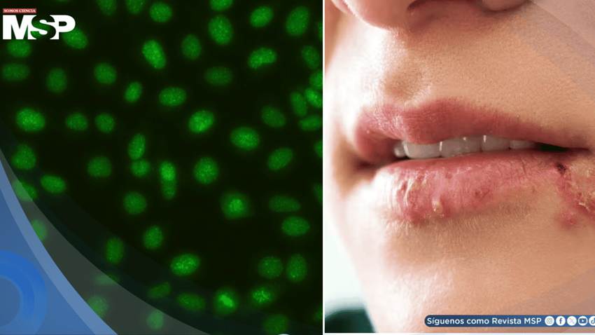 El bloqueo de la enzima topoisomerasa I podría detener la infección por herpes simple tipo 1