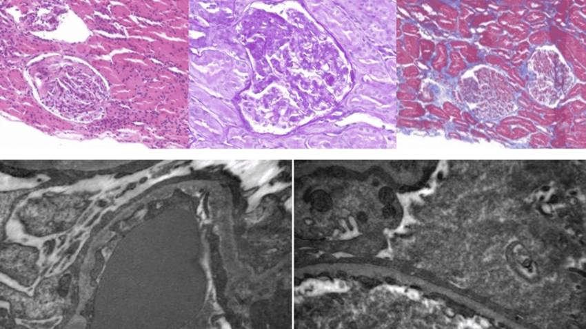 Insuficiencia renal progresiva en paciente en embarazo revela glomeruloesclerosis segmentaria focal