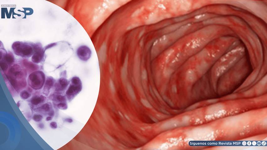 Científicos descubren que la proteína STING desencadena la inflamación en la colitis ulcerosa