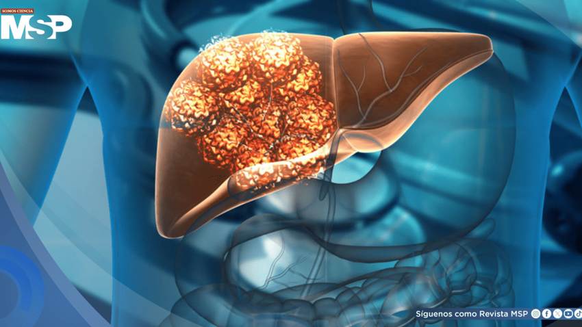 El 60% de los casos de cáncer de hígado se pueden prevenir, según estudio