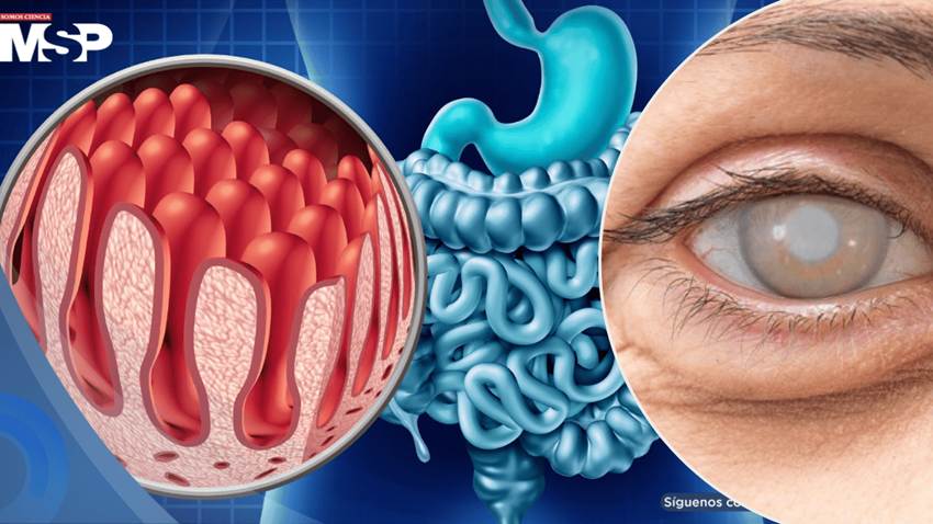 ¿Tiene intolerancia al gluten? Así podría verse afectada su salud ocular