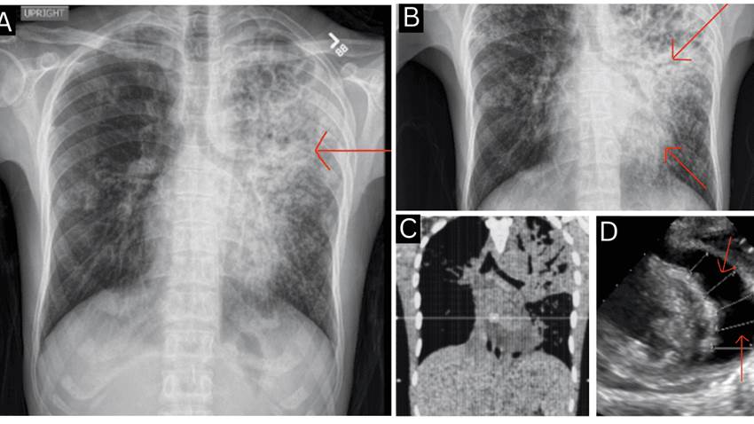 Tos persistente y dolor torácico revelan tuberculosis pericárdica con taponamiento cardíaco en joven