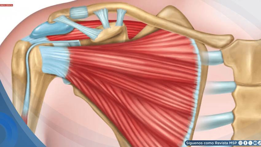 Tendinitis del manguito rotador