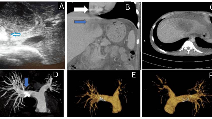Absceso hepático amébico rompe la vena cava inferior y causa embolia pulmonar masiva en paciente