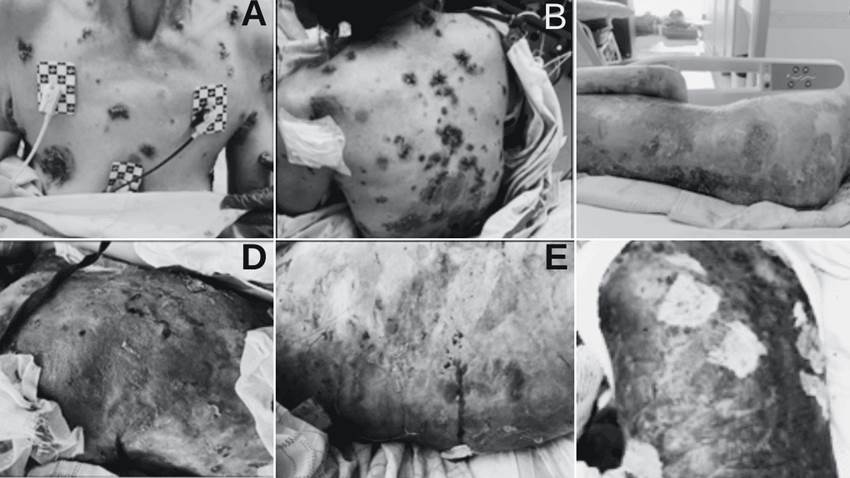 Pénfigo vulgar refractario a corticoides tratado con éxito con rituximab sin dermatología hospitalaria