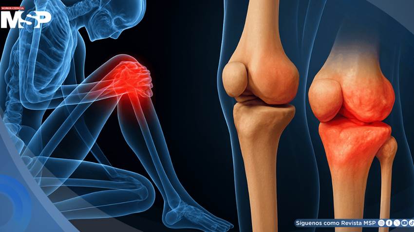 La condrocalcinosis podría aumentar 75% el riesgo de desarrollar osteoartritis de rodilla, según estudio
