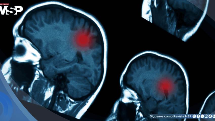 Traumatismos craneoencefálicos moderados y graves aumentan el riesgo de tumores cerebrales malignos