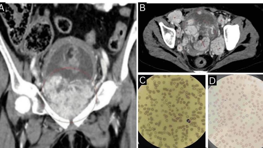 Paciente con feocromocitoma metastásico presentó anemia hemolítica microangiopática paraneoplásica