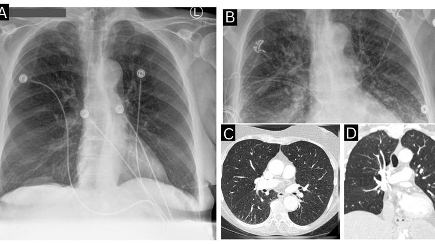 Picadura de garrapata provoca miocardiopatía de Takotsubo y shock cardiogénico por babesiosis