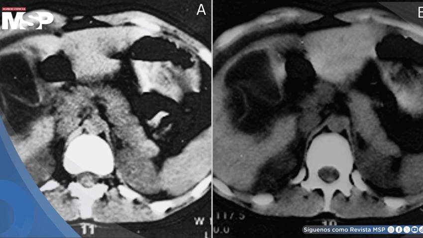 Quiste hidátido hepático se rompe tras abrazo de oso: Paciente desarrolla dolor abdominal y urticaria