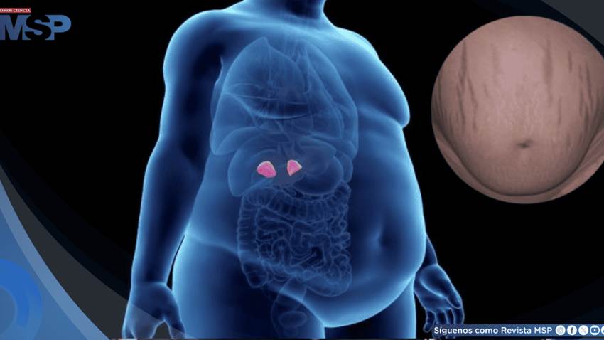 Enfermedad de Cushing, trastorno hormonal causado por un tumor en la hipófisis