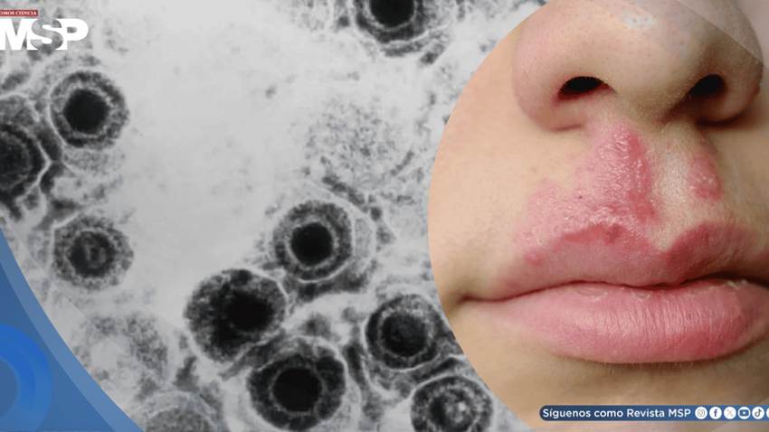 Desarrollan un nuevo antiviral efectivo contra cepas resistentes del virus del herpes