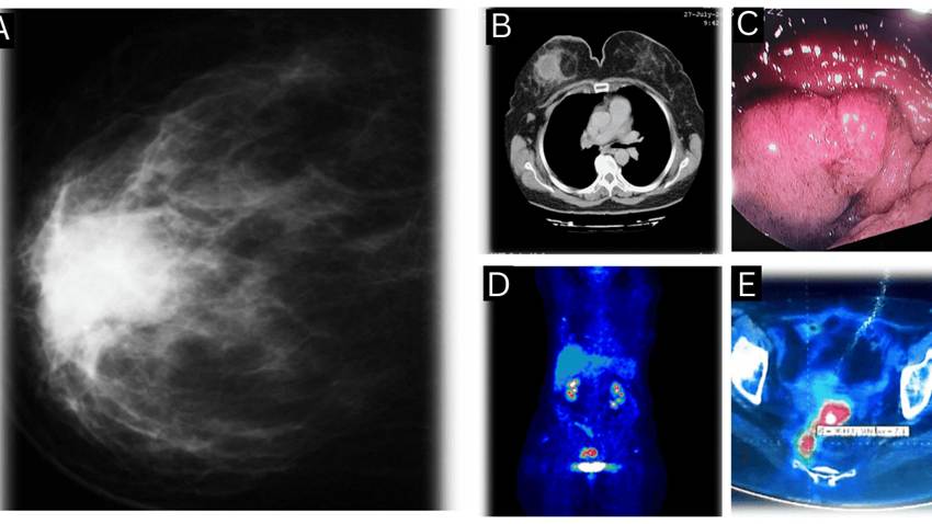 Carcinoma mamario triple negativo y adenocarcinoma rectal sincrónico en paciente con BRCA1 y hepatitis B