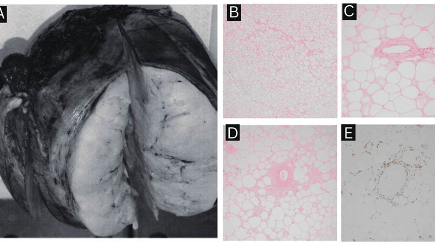 Detección incidental de lipoma uterino intramural en mujer posmenopáusica por infecciones urinarias