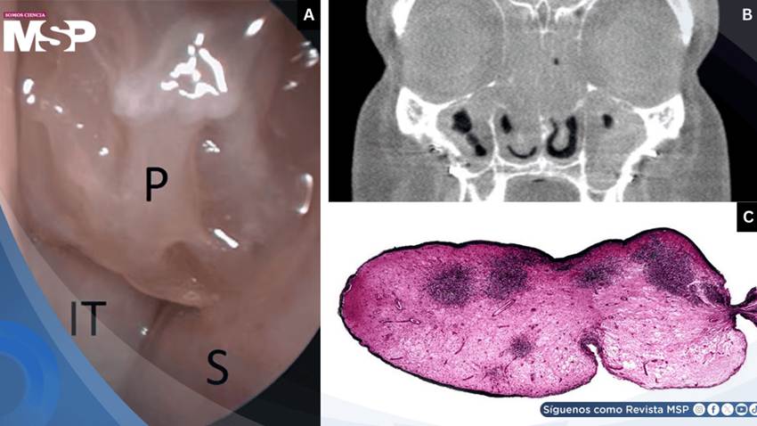 Poliposis nasal bilateral, anosmia y crisis asmáticas desencadenadas por AINEs y aspirina