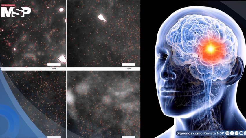 Detectan por primera vez los oligómeros de alfa-sinucleína, proteínas que marcan el inicio del párkinson