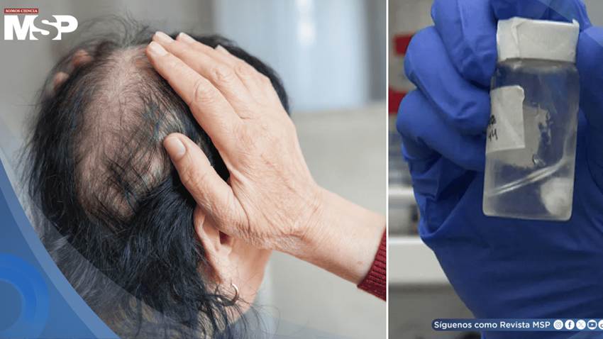 Desarrollan gel experimental que podría prevenir la caída de cabello durante la quimioterapia