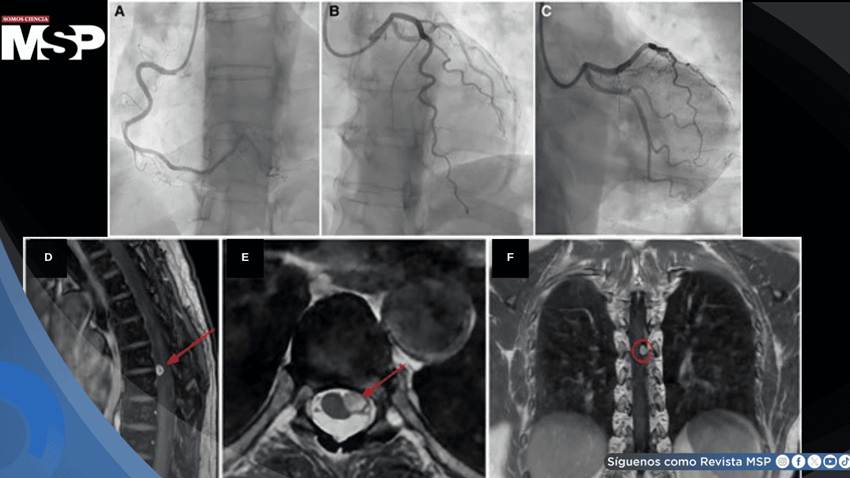 Dolor torácico persistente sin obstrucción coronaria resulta en schwannoma espinal torácico compresivo