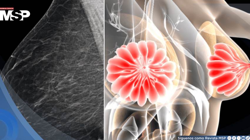 Descubren que la densidad mamaria podría dificultar la detección del cáncer de mama