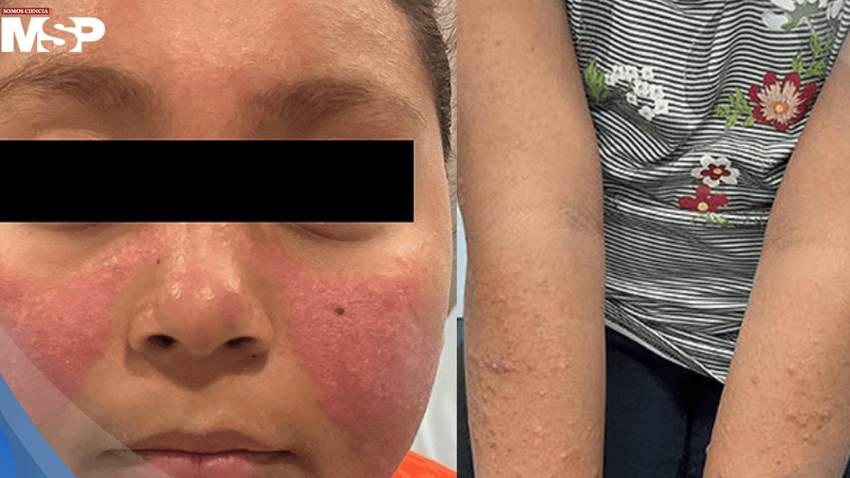 Erupción facial fotosensible lleva al diagnóstico de lupus eritematoso sistémico en paciente pediátrica