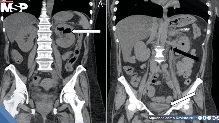 Pielitis enfisematosa fulminante en paciente diabética: Diagnóstico y resolución tras drenaje percutáneo