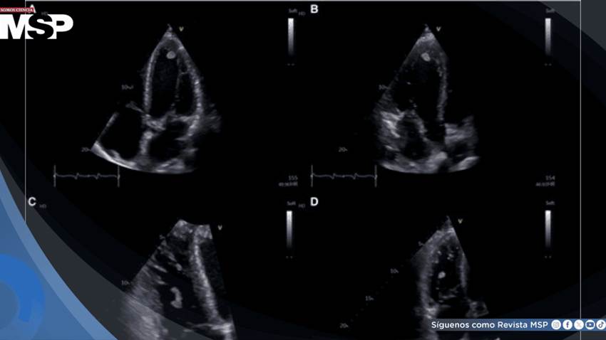 Neumonía por Mycoplasma y aleteo auricular desencadenan trombos biventriculares en paciente joven