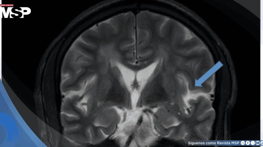 Síndrome de encefalopatía posterior reversible asociado a crisis hipertensiva con estado epiléptico