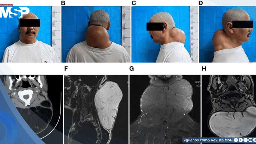 Detectan lipoma gigante posterior del cuello de 20 cm con características adiposas encapsuladas