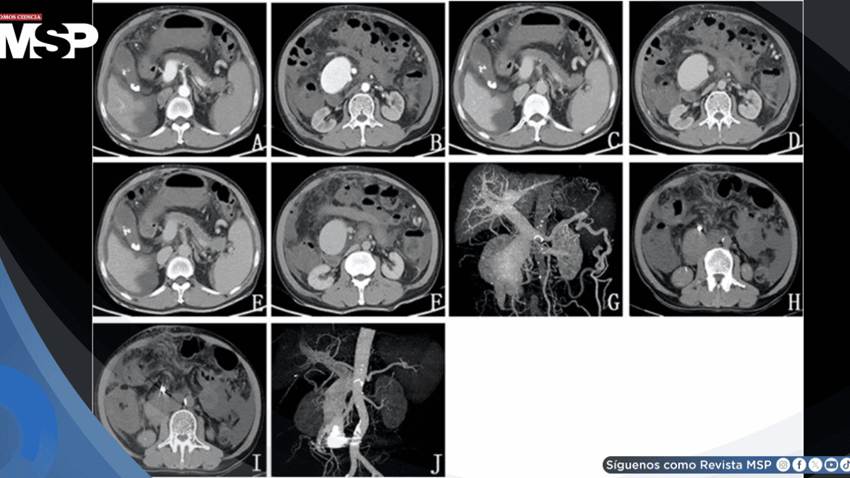 Ictericia, dolor abdominal y heces negras revelan fístula arteriovenosa mesentérica postraumática