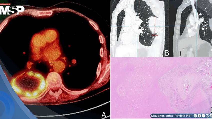 Carcinoma pulmonar oculto tras dolor lumbar y ciática: Pseudoprogresión después de terapia neoadyuvante