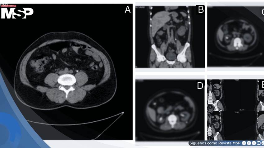 Stent ureteral anudado e incrustado tras retención prolongada en paciente con litiasis e hidronefrosis