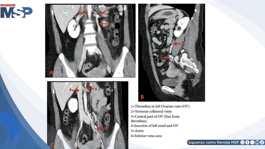 Trombosis venosa ovárica izquierda en mujer con dolor abdominal progresivo y masa cordonal palpable