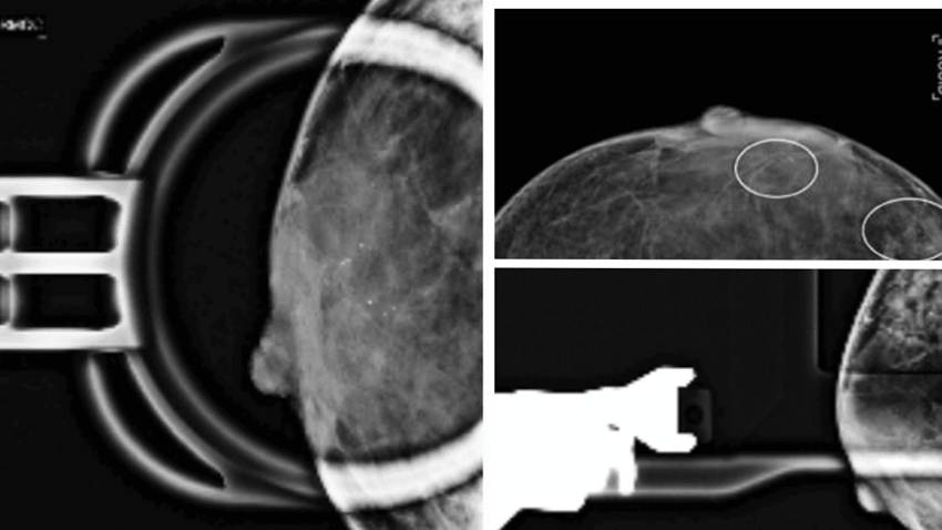 Paciente presenta cáncer de mama con distintos tipos de tumor y características moleculares diferentes