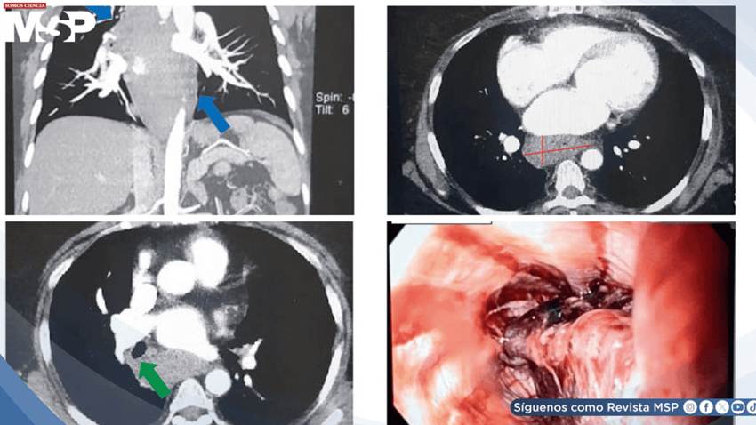Hematoma esofágico intramural imitó un síndrome coronario agudo en paciente anticoagulada