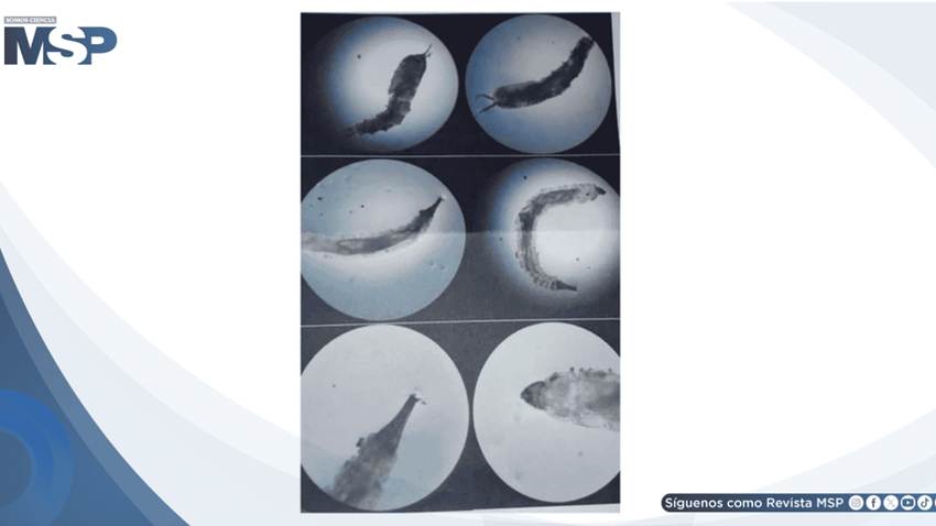 Diagnóstico tardío de miasis urogenital provoca necrosis y compromiso vesicouretral