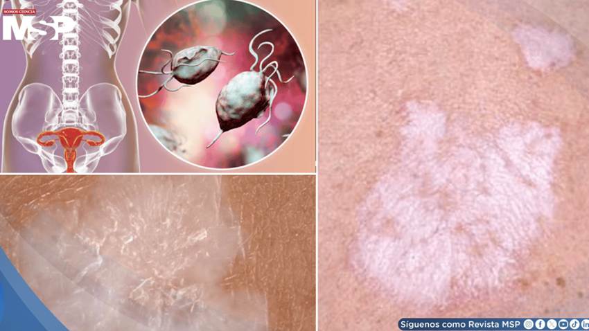 Ardor y prurito en la zona genital: Así se reconoce y trata el liquen escleroso